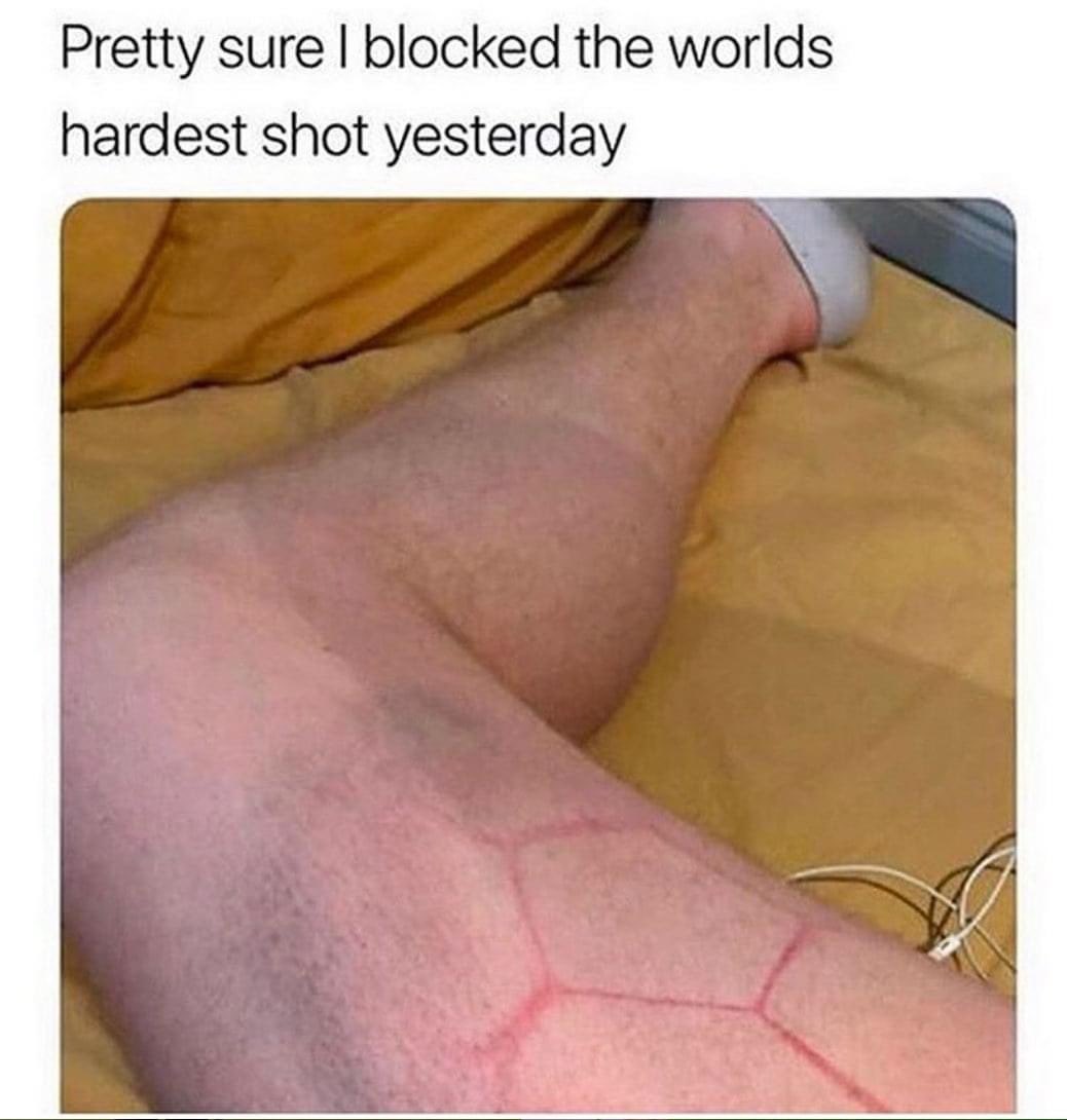 __HannahJade__'s tweet photo. Did you even play football if you never had one of these marks, 10x worst in the winter when it’s freezin

(Clearly no my leg before any cheeky cunt pipes up ) https://t.co/ebpBt3rRLI