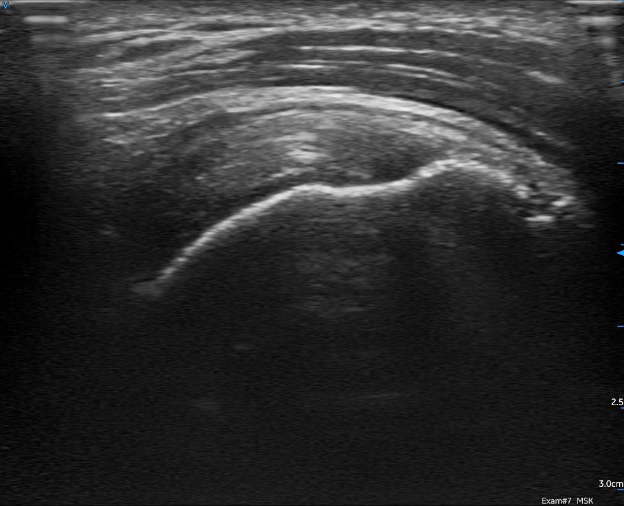 sdbunting's tweet photo. Trialing the brand new @GEHealthcare @vscan air today. Very impressed with image quality from such a small unit. A selection of shoulder images, including a Hill Sachs lesion, with the linear probe 1/2 @8geo8 @RepSwalwell @mike61668028 @CMyersPhysio @SteveHi94456620 #POCUS https://t.co/o1mjQ3VkBK