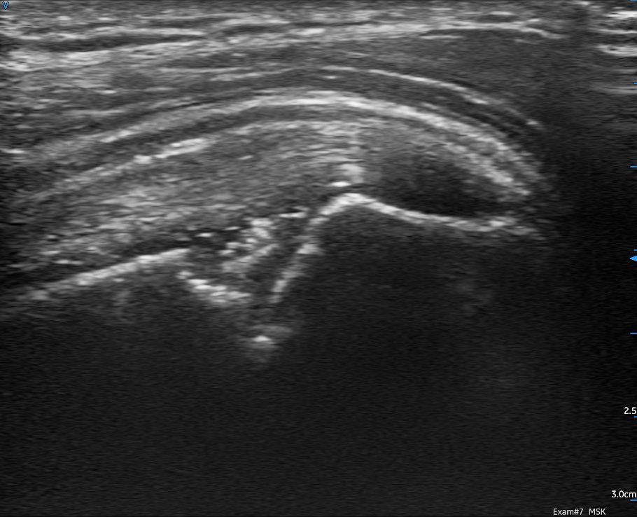 sdbunting's tweet photo. Trialing the brand new @GEHealthcare @vscan air today. Very impressed with image quality from such a small unit. A selection of shoulder images, including a Hill Sachs lesion, with the linear probe 1/2 @8geo8 @RepSwalwell @mike61668028 @CMyersPhysio @SteveHi94456620 #POCUS https://t.co/o1mjQ3VkBK