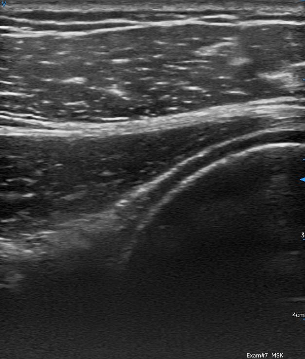 sdbunting's tweet photo. Trialing the brand new @GEHealthcare @vscan air today. Very impressed with image quality from such a small unit. A selection of shoulder images, including a Hill Sachs lesion, with the linear probe 1/2 @8geo8 @RepSwalwell @mike61668028 @CMyersPhysio @SteveHi94456620 #POCUS https://t.co/o1mjQ3VkBK