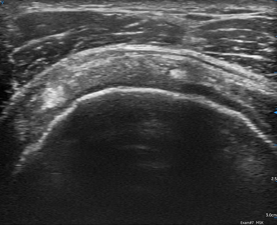 sdbunting's tweet photo. Trialing the brand new @GEHealthcare @vscan air today. Very impressed with image quality from such a small unit. A selection of shoulder images, including a Hill Sachs lesion, with the linear probe 1/2 @8geo8 @RepSwalwell @mike61668028 @CMyersPhysio @SteveHi94456620 #POCUS https://t.co/o1mjQ3VkBK