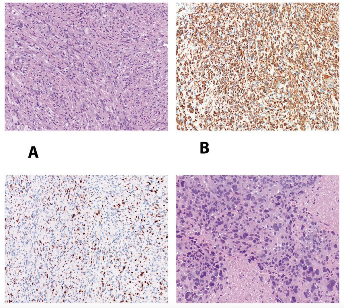 JCloutierMD's tweet photo. Inflammatory rhabdomyoblastic tumor with progression to high-grade rhabdomyosarcoma and aggressive clinical behavior. 

Most cases seem to follow an indolent clinical course, but there appear to be rare exceptions.

➡️ https://t.co/GZqcsHMz6A

#BSTPath @ModernPathology https://t.co/c2OXWVnxK4