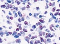 AJCPjournal's tweet photo. These authors found INSM1 expression is not exclusive to neuroendocrine carcinomas and should be correlated with other clinicopathologic and immunohistochemical features. https://t.co/RoJPRibUoF https://t.co/dLQWfoe7B8