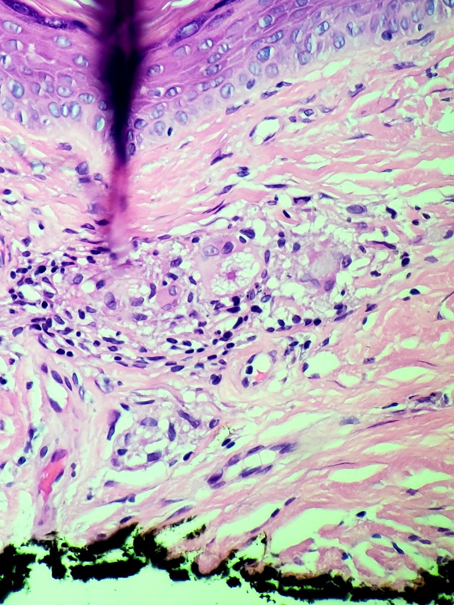 DrSarahDerm's tweet photo. It's the little things... like finding asteroid bodies in your granulomata. ๐คฉโ #dermnerd #pathology #dermpath #dermatopathology #dermatopathologist #sarcoidosis #granuloma #asteroid https://t.co/xJRZ30TkxD