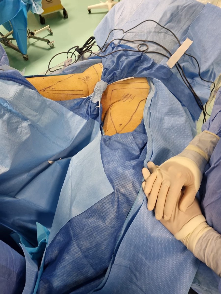 tom_silvestri's tweet photo. The beauty of minimally invasive surgery https://t.co/rhRcQm4Jlb