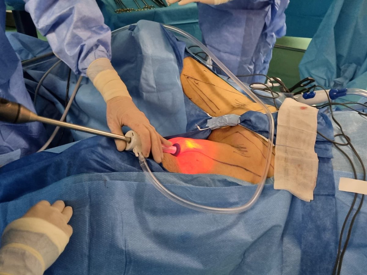 tom_silvestri's tweet photo. The beauty of minimally invasive surgery https://t.co/rhRcQm4Jlb
