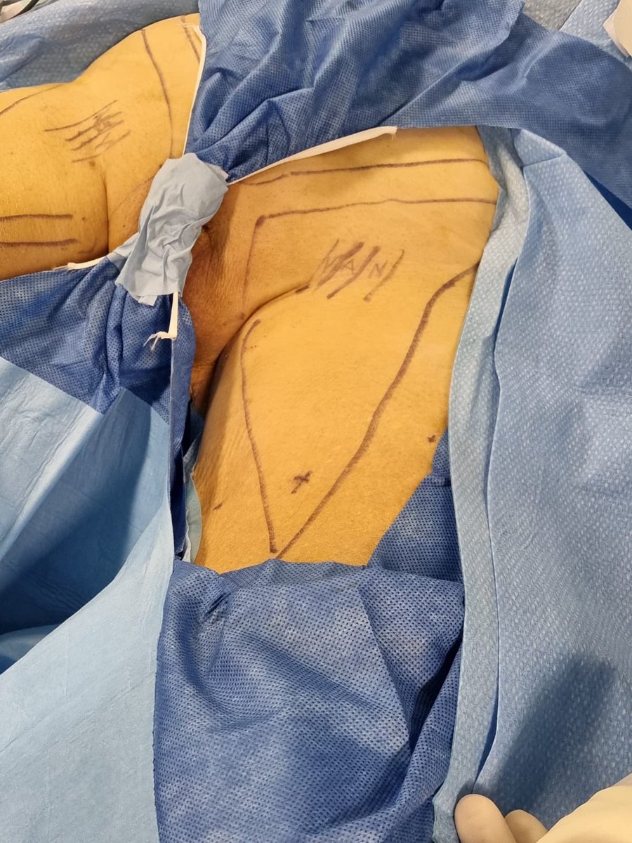 tom_silvestri's tweet photo. The beauty of minimally invasive surgery https://t.co/rhRcQm4Jlb
