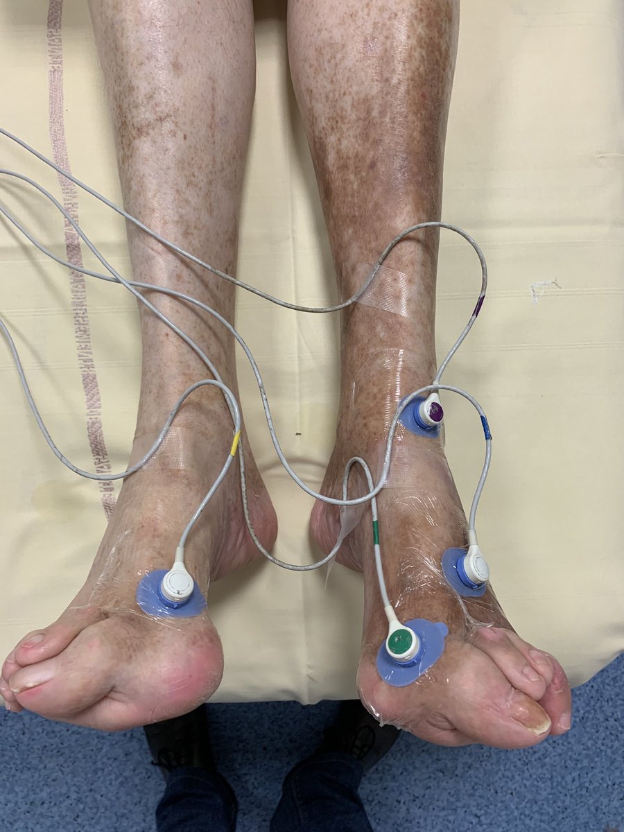 GMahe_'s tweet photo. Tonight More than 300 vascular physicians for the live webinar of @lasfmv about #TCPO2 Nice to see that people are interested by this method @perimedgroup @RadiometerMed https://t.co/gpwCxW534i