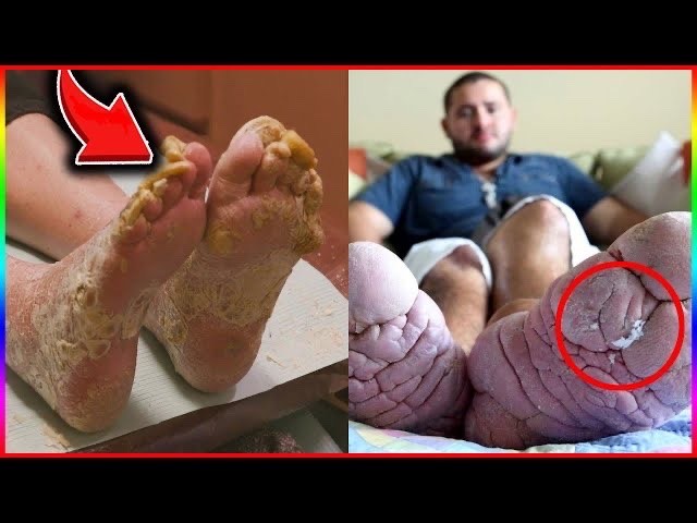 YTFilmTruth's tweet photo. Have You Seen the Grossest Moments on My Feet Are killing Me?
https://t.co/KzmBXPmCzy
#onlyfans #Netflix #strangerthings #viralvideo #footsurgery #cycsts #callases #toenail #toenails #footfungus #dryfeet #dryskin #thetoebro #toebro
https://t.co/UndOX0wTnM 👍🥰💻😀🤮 https://t.co/YpjGxl3MqG