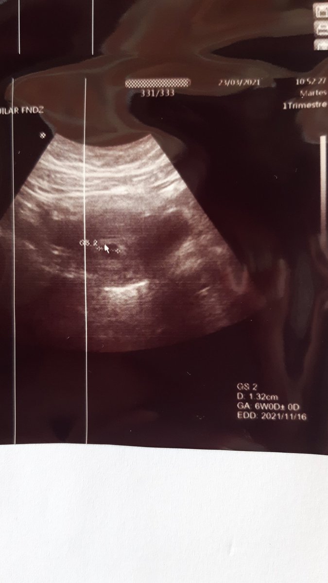 sighmochi's tweet photo. AMIS LES PRESENTO A MI FRIJOLITOOOOO, TIENE 5 SEMANAS 6 DÍAS Y PUEDE QUE NAZCA EN NOVIEMBRE 🥰💜 https://t.co/8M8dT3x4By
