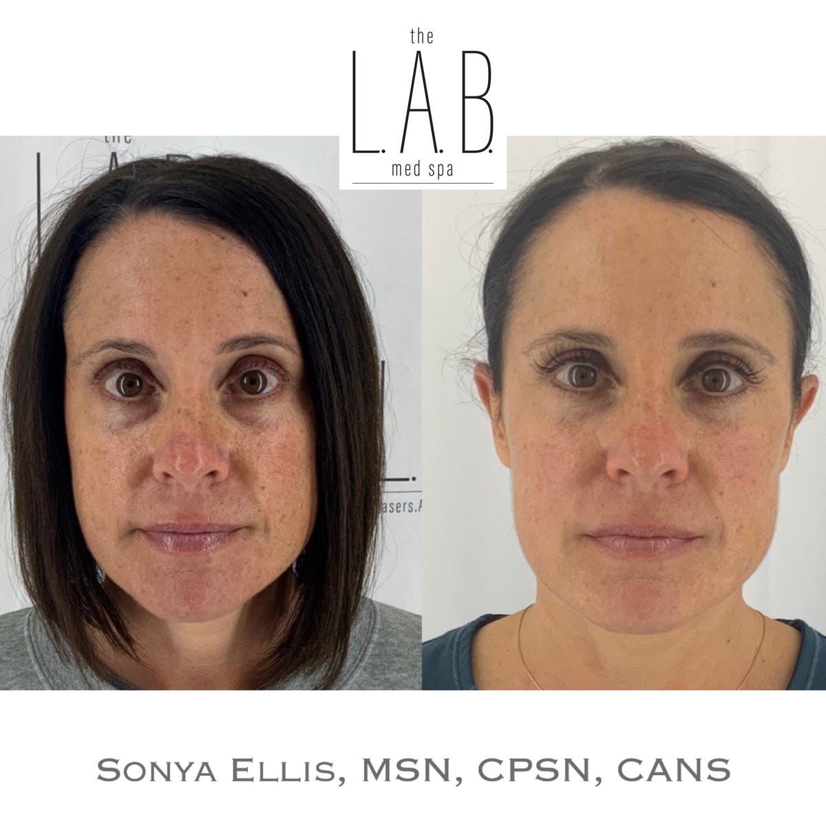thelabmedspa's tweet photo. These results are brought to you after one treatment of PRF and 3 months of using our FACE CRACK
Call today to schedule your consultation with one of our fabulous aesthetic nurse injectors, aestheticians or laser technicians.
817-251-1000 #PRF #DHR #facecrack #southlake #medspa https://t.co/2dVlfXJQlA