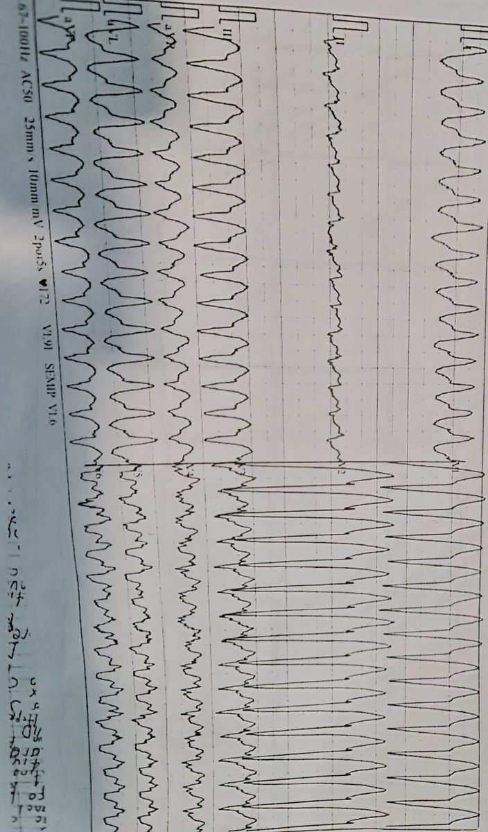 IMAGEN DE HOY |
#cardiotwitter #aprendiendoasermédico 

Masculino que llega por disnea y dolor precordial.

¿Qué hacemos?