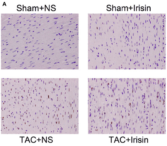 AmandaFregonas's tweet photo. #CardiacRemodeling 🫀occurs from changes in myocyte structure &amp; can lead to #HF. A new study examined the effects of a protein hormone called #Irisin in rats &amp; found that it ⬇️ the apoptotic rate (TUNEL pos %) of myocytes, among many outcomes #biom4180
https://t.co/L9p0OfRBar https://t.co/dwAzTp5fCr