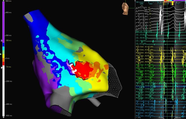EPbytheBay's tweet image. RA atypical flutter with prior atriotomy. #HDGrid mapped full circuit and helped identify lines of block. Flutter broke quickly by burning through channel and down to the IVC! @AbbottCardio #EPeeps Prop/sparkle maps to follow...(1/3)