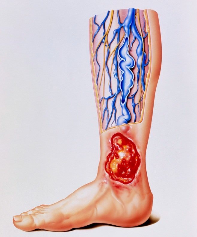 AMTwoundcare's tweet photo. 80% of Leg Ulcers Caused By Venous Insufficiency | Learn How To Recognize the 5 Etiologies Critical for Effective Treatment | Continuing Education Webinar

Complimentary Registration:  https://t.co/HMTQP6Z7dJ  Compression &amp; Wound Management   
April 22  2-3:15 PM EDT https://t.co/nTGYfOYEvz