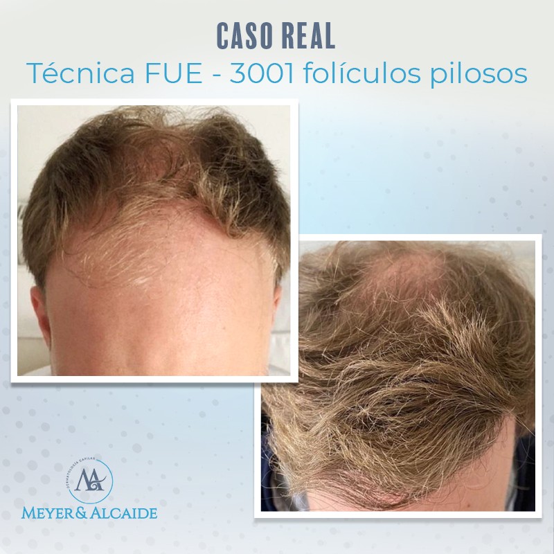 MeyeryAlcaide's tweet photo. Os mostramos los resultados que puedes obtener gracias a la #TécnicaFUE. En esta ocasión, se han trasplantado 3.001 #folículos y ¡este fue el resultado! 

Recupera tu imagen 😉 con expertos 🧑‍⚕️👩‍⚕️ en #ImplanteCapilar sin salir de #Málaga 🏝️

Consúltanos 📲 al 625 29 09 33 https://t.co/nhxYQdRkXW