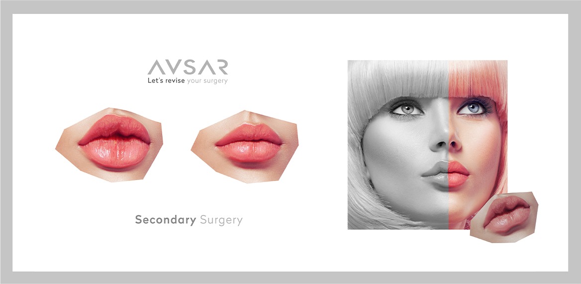 What do you know about Revision surgeries? 
to know What is Secondary Surgery? what are the Reasons for Secondary Surgery? and for more information make sure to visit our website.
avsarclinic.com/secondary-surg…
#revision #secondary #endoscopic #plasticsurgery  #reconstructivesurgery