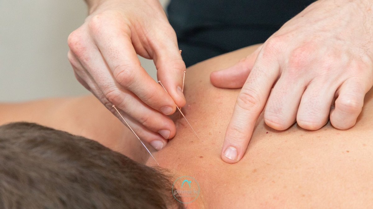 PinnacleFH's tweet photo. Acupuncture is one of the many skills used within physiotherapy as an integrated approach to the management of pain and inflammation and as a means of stimulating the body’s own healing chemicals in order to aid recovery and enhance rehabilitation.

#acupuncture #physio https://t.co/mlreQxJNjy