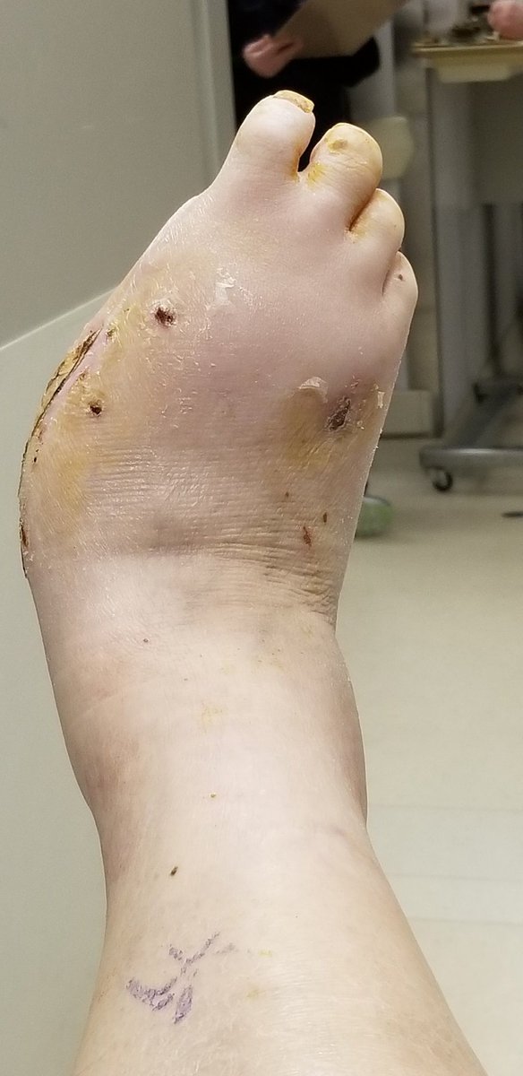 HalMyshrall's tweet photo. So it's been just over 21 days now since Doctor Joyce Fu  did the surgery to fix my foot and save it from amputation which there was never any need to. I now have almost full range of  motion which I have not had in years the pressure wound is almost heal the doctor is very happy https://t.co/dPzEGT68dE