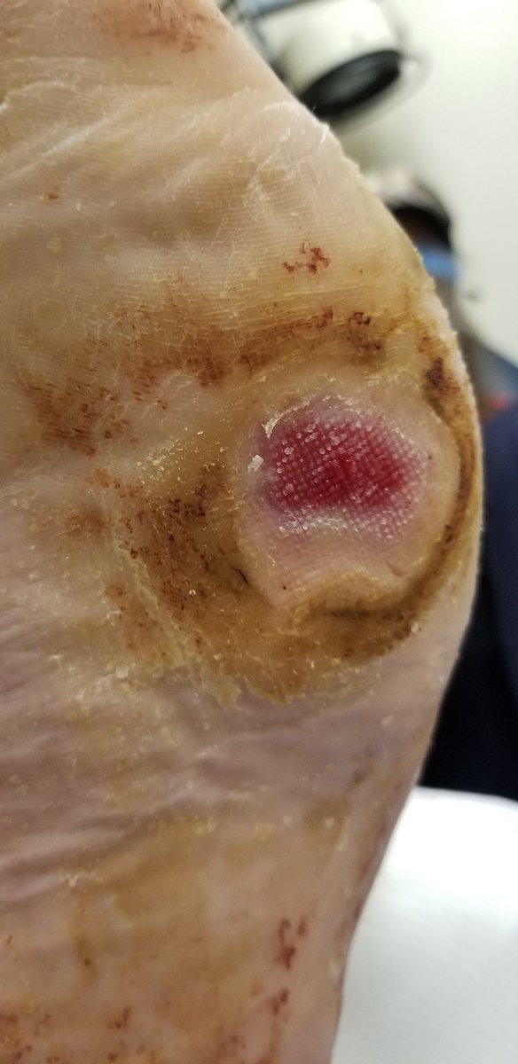 HalMyshrall's tweet photo. So it's been just over 21 days now since Doctor Joyce Fu  did the surgery to fix my foot and save it from amputation which there was never any need to. I now have almost full range of  motion which I have not had in years the pressure wound is almost heal the doctor is very happy https://t.co/dPzEGT68dE