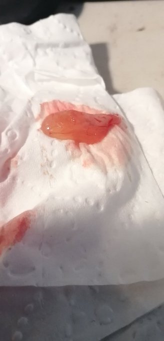 Meet Fred, he came out my nose, Fred has lived in there for 6+years.   He finds himself on the outside