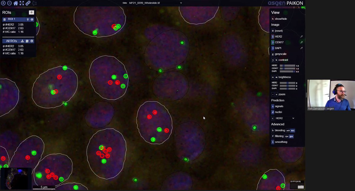 TheEMPAIA's tweet photo. Next presentation is by Falk Zakrzewski from #ASGEN about their product #PAIKON: “Automated HER2 gene amplification analysis on FISH Whole Slide Image” #BreastCancer #BreastCancerResearch #CancerResearch #DigitalPathology #ComputationalPathology https://t.co/sHBBeKDovm