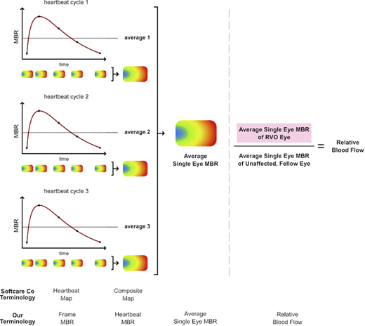 ARVOtvst's tweet image. New and free to read now: "Relative Retinal Blood Flow: A Novel and Informative Measure of Unilateral Retinal Vein Occlusion Severity."

doi.org/10.1167/tvst.1… @BIDMChealth #CRVO #BRVO #retina #imagine #OpenAccess