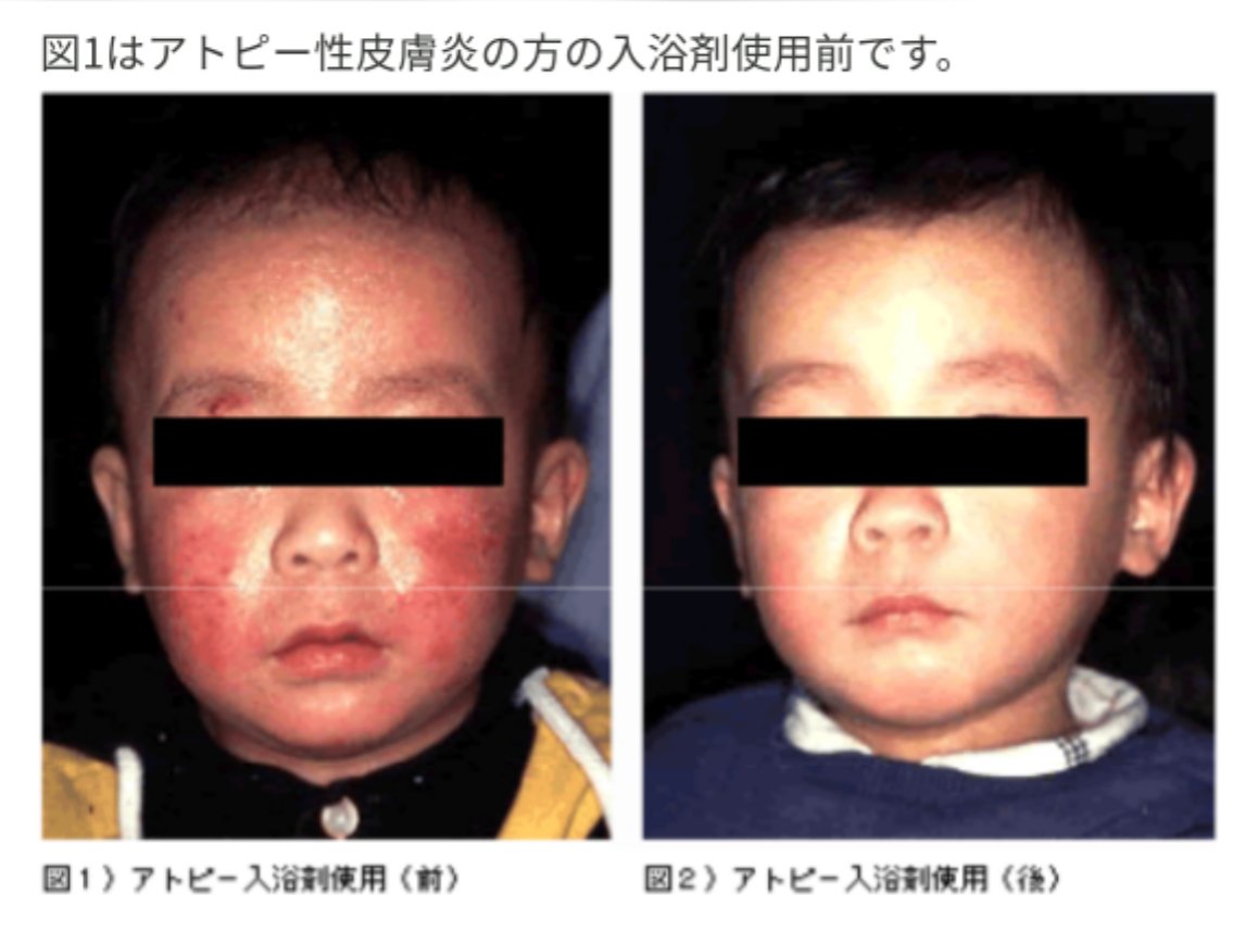 Miracle Splash アトピー性皮膚炎の患者さんに塩化mg入りの入浴剤を使用して頂いたところ 約5割の患者さんで症状の改善がみられました また患者さんの家族の方がmg入りのお風呂に入ると 肌がスベスベになる しもやけができない 冷え性が改善した
