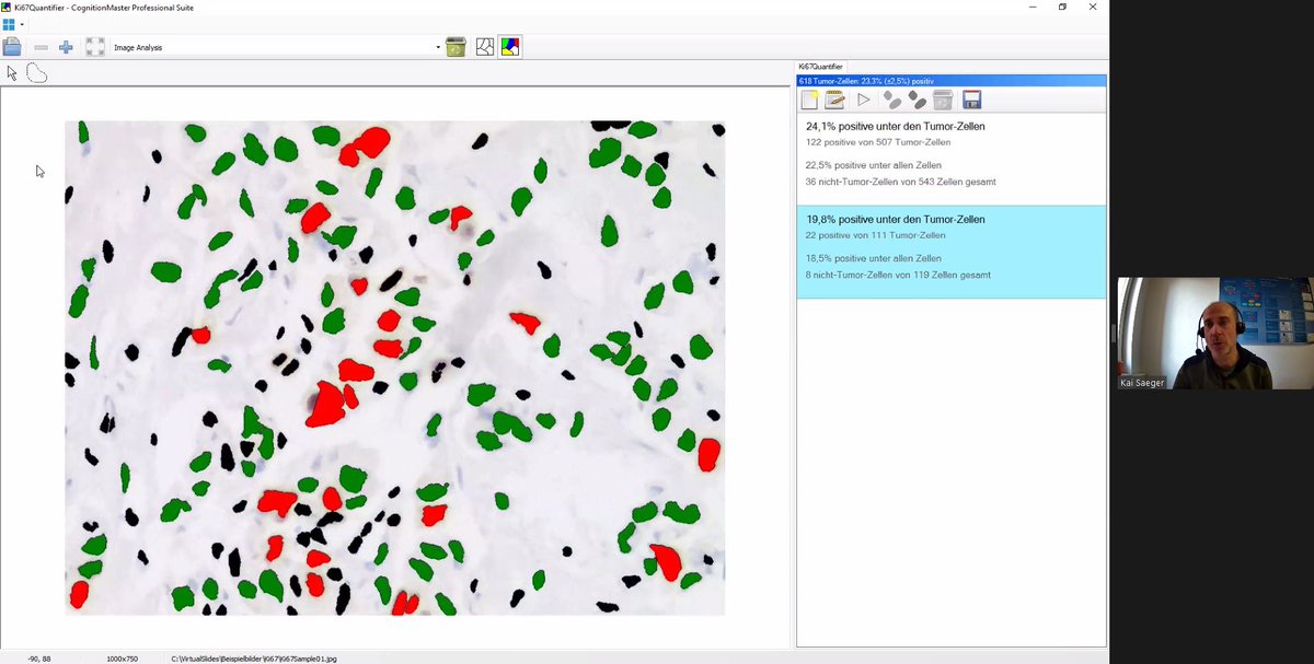 TheEMPAIA's tweet photo. Kai Saeger of #VMscope GmbH demonstrating live quantification of various markers, incl. Ki-67, HER2, ER, PR | #DigitalPathology #ComputationalPathology #DeepLearning #CancerResearch #ClinicalValidation https://t.co/zZQb9Y5P6L
