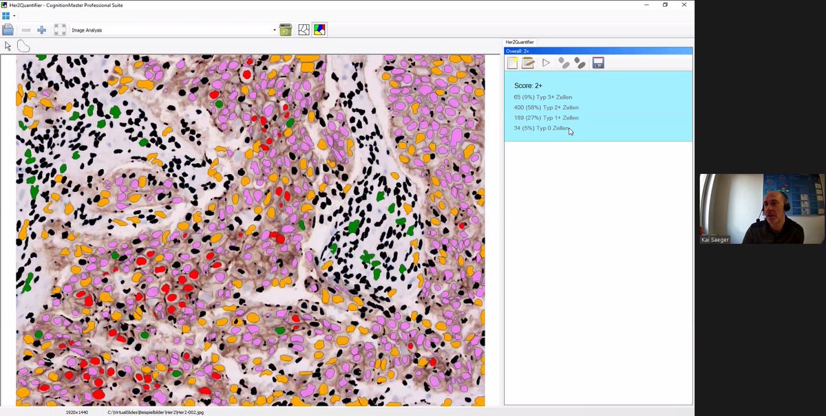 TheEMPAIA's tweet photo. Kai Saeger of #VMscope GmbH demonstrating live quantification of various markers, incl. Ki-67, HER2, ER, PR | #DigitalPathology #ComputationalPathology #DeepLearning #CancerResearch #ClinicalValidation https://t.co/zZQb9Y5P6L
