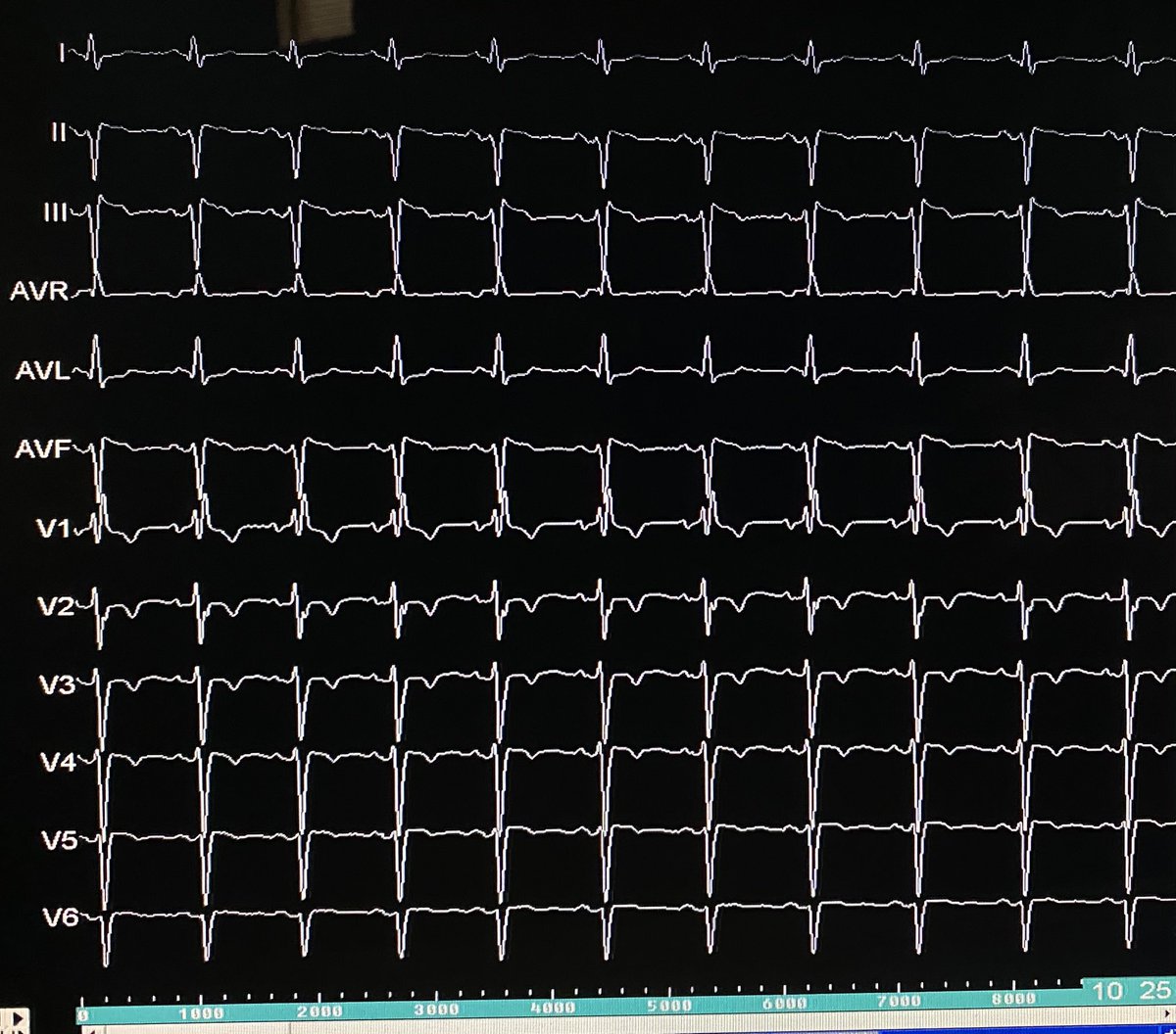 CarinaHardyEP (@carinahardy4) on Twitter photo Summit PVC ablation as in the old times. Zero 3Dmap 🤣🤣
Recurrente by LV endo (farfield 38ms), success was achieved by GCV with 42ms prec.
<a href="/RodrigoMK2101/">Rodrigo Kulchetscki</a> <a href="/alexandra_regia/">Alexandra R. D. Brigido</a> <a href="/FelipeKalil11/">Felipe Kalil</a> <a href="/Scanav1Mauricio/">Mauricio Scanavacca</a> <a href="/gabriela_rassi/">Gabriela Rassi</a> <a href="/MarinaMayrink2/">Marina Mayrink</a> <a href="/el_andere/">Tamer El Andere</a> #InCor #epeeps Summit PVC ablation as in the old times. Zero 3Dmap 🤣🤣
Recurrente by LV endo (farfield 38ms), success was achieved by GCV with 42ms prec.
<a href="/RodrigoMK2101/">Rodrigo Kulchetscki</a> <a href="/alexandra_regia/">Alexandra R. D. Brigido</a> <a href="/FelipeKalil11/">Felipe Kalil</a> <a href="/Scanav1Mauricio/">Mauricio Scanavacca</a> <a href="/gabriela_rassi/">Gabriela Rassi</a> <a href="/MarinaMayrink2/">Marina Mayrink</a> <a href="/el_andere/">Tamer El Andere</a> #InCor #epeeps