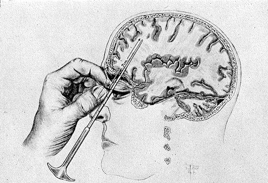 Inside lobotomies

Our collection of articles from the archive on lobotomy

thepsychologist.bps.org.uk/inside-lobotom…