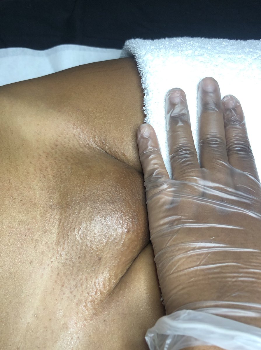 likkleli0n's tweet photo. #BaldOrBust! 👩🏾‍🦲🤩 IG:levbeautybar 
And yes, we use hard wax🥳 (Kingston,Jamaica) https://t.co/zHoTVRMVHT