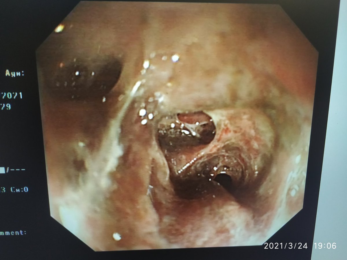 sentigastro's tweet photo. 87 male,multiple comorbidities , apixaban for aF , last dose yesterday , came with UGI bleed
Gastroscopy 👇
What do you think is happening here
Never saw this in my life
#MedTwitter22 #GITwitter #LiverTwitter #ugibleed https://t.co/rxCrvxPWxM