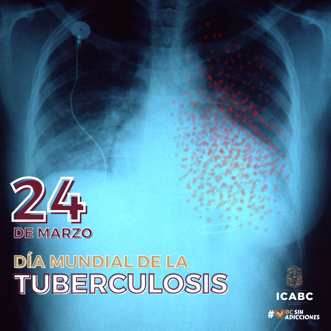 BC_ICA's tweet photo. ⚠️#BCSinAdicciones⚠️| Día Mundial de la Tuberculosis

Hace mucho tiempo, específicamente en el año de 1882 el Dr. Robert Koch descubrió una bacteria que provoca molestias en los pulmones, llamándola #tuberculosis. En el mismo descubrimiento también generó su diagnóstico y además https://t.co/YfwFa5BIhT