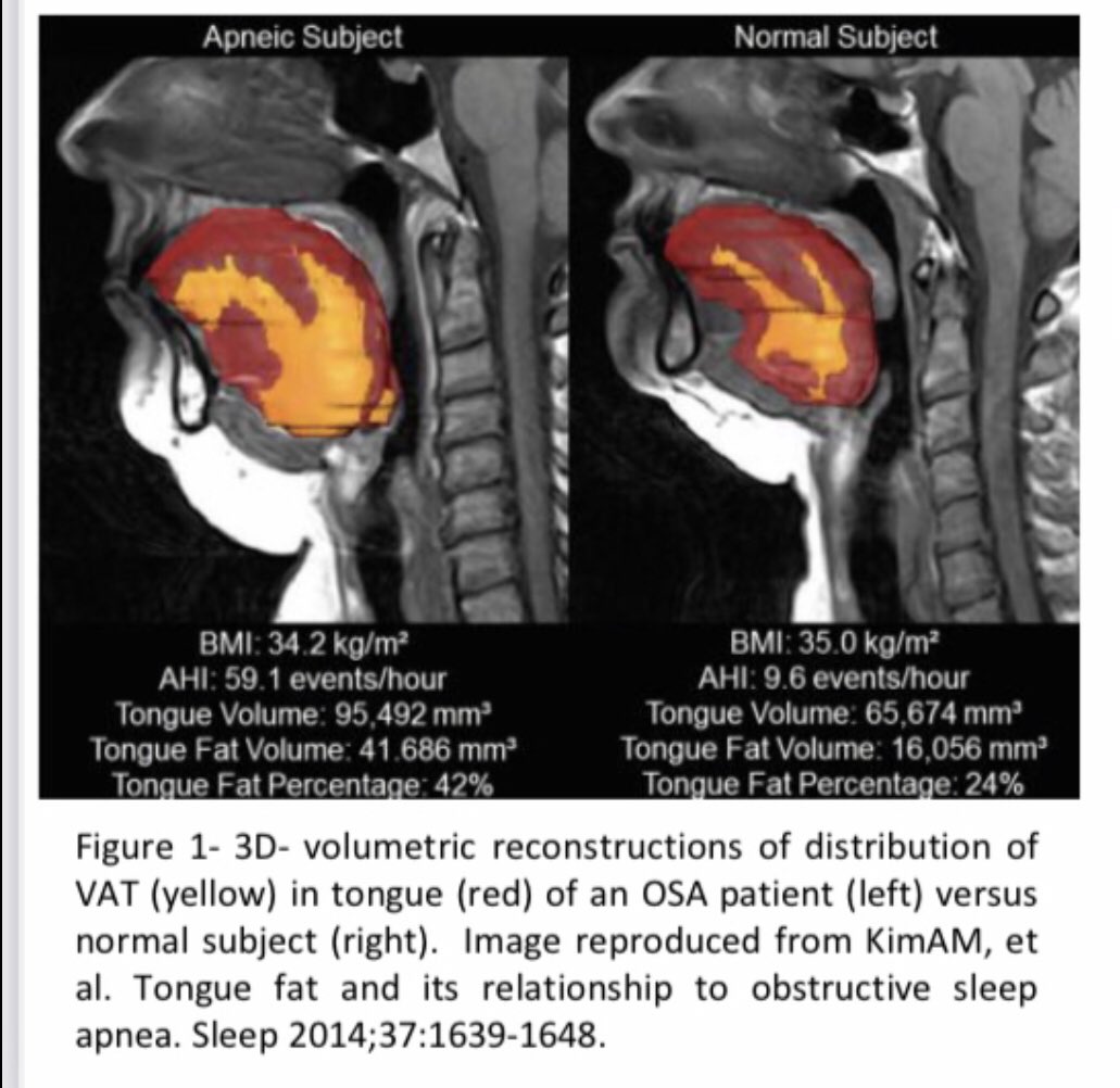 upyrbike's tweet photo. 💥”fatty tongue” contributes to OSA
💥it is rapidly reversible #lowcarb
💥reversibility is independent of body-weightloss

#metabolicairway 🧐 https://t.co/IqtpbGshLL