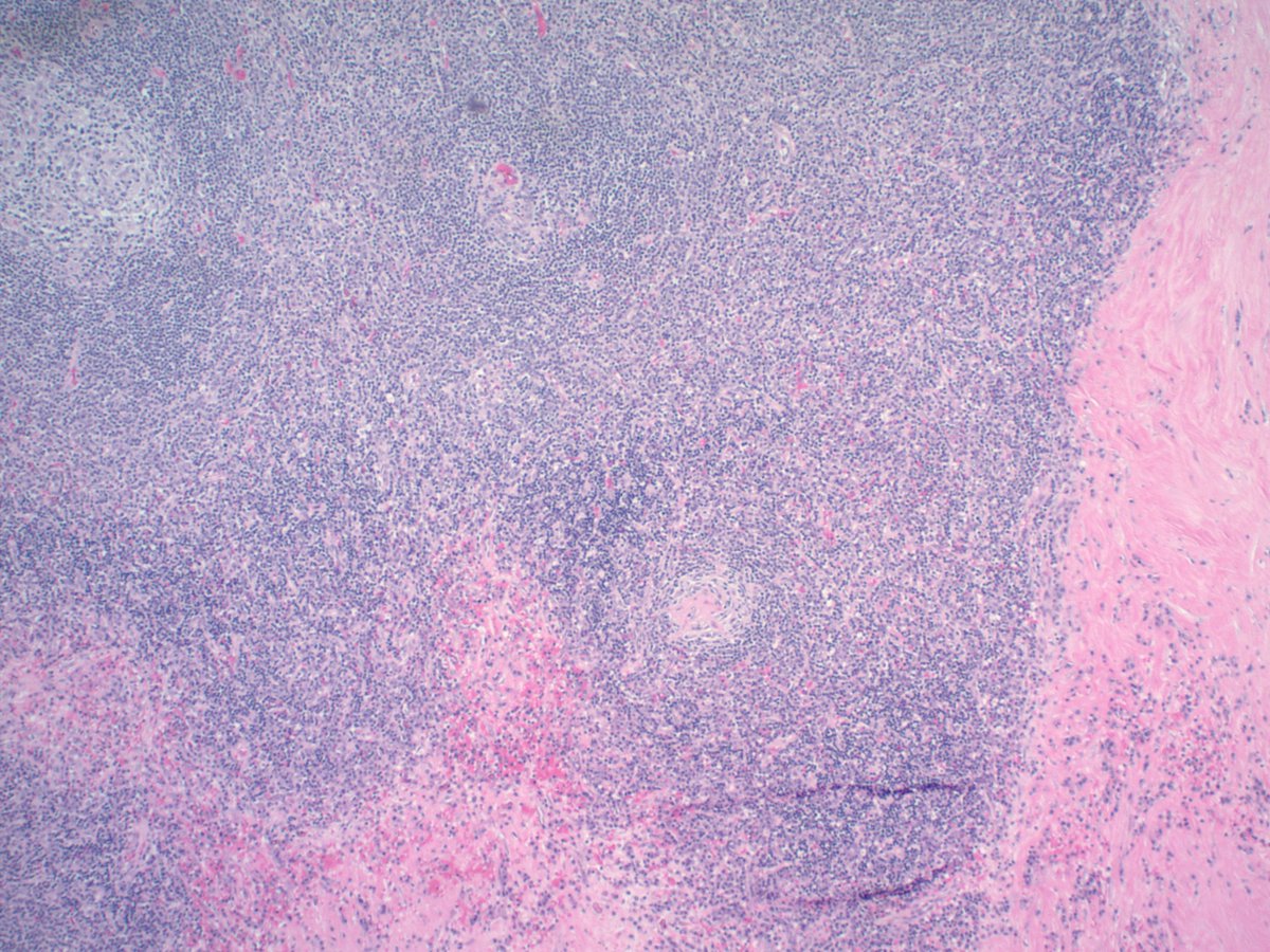 MinaXu7's tweet photo. External iliac lymph node of a 60 year old man with TdT immunostain in left lower corner.  What's your differential? https://t.co/mzQhl9ZZJa