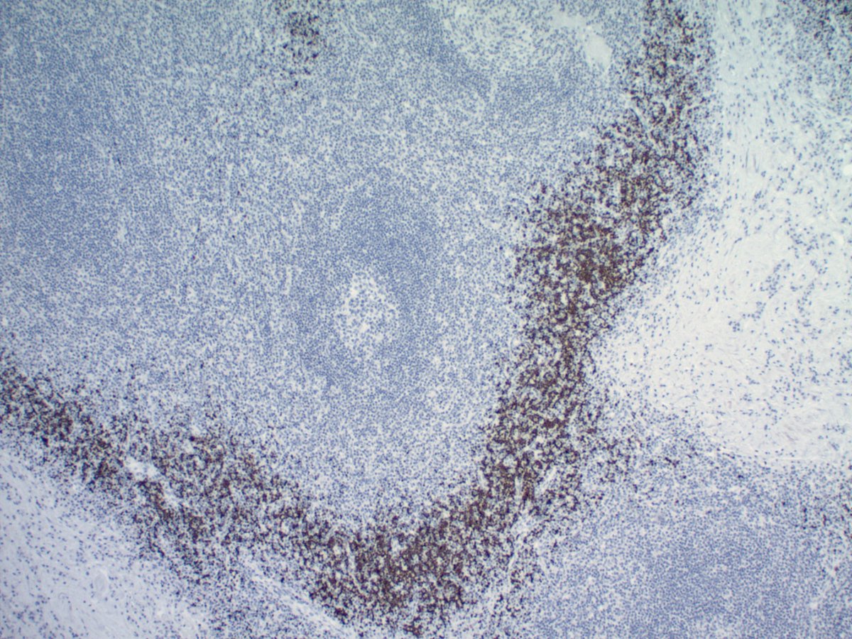 MinaXu7's tweet photo. External iliac lymph node of a 60 year old man with TdT immunostain in left lower corner.  What's your differential? https://t.co/mzQhl9ZZJa
