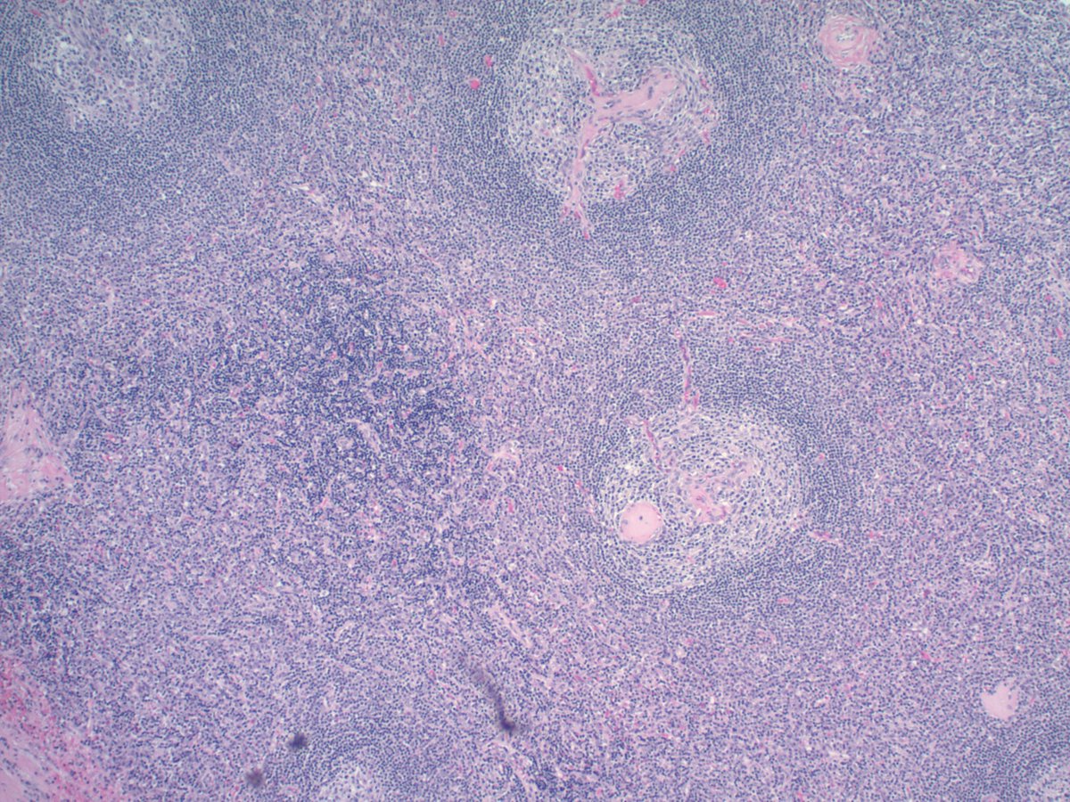 MinaXu7's tweet photo. External iliac lymph node of a 60 year old man with TdT immunostain in left lower corner.  What's your differential? https://t.co/mzQhl9ZZJa