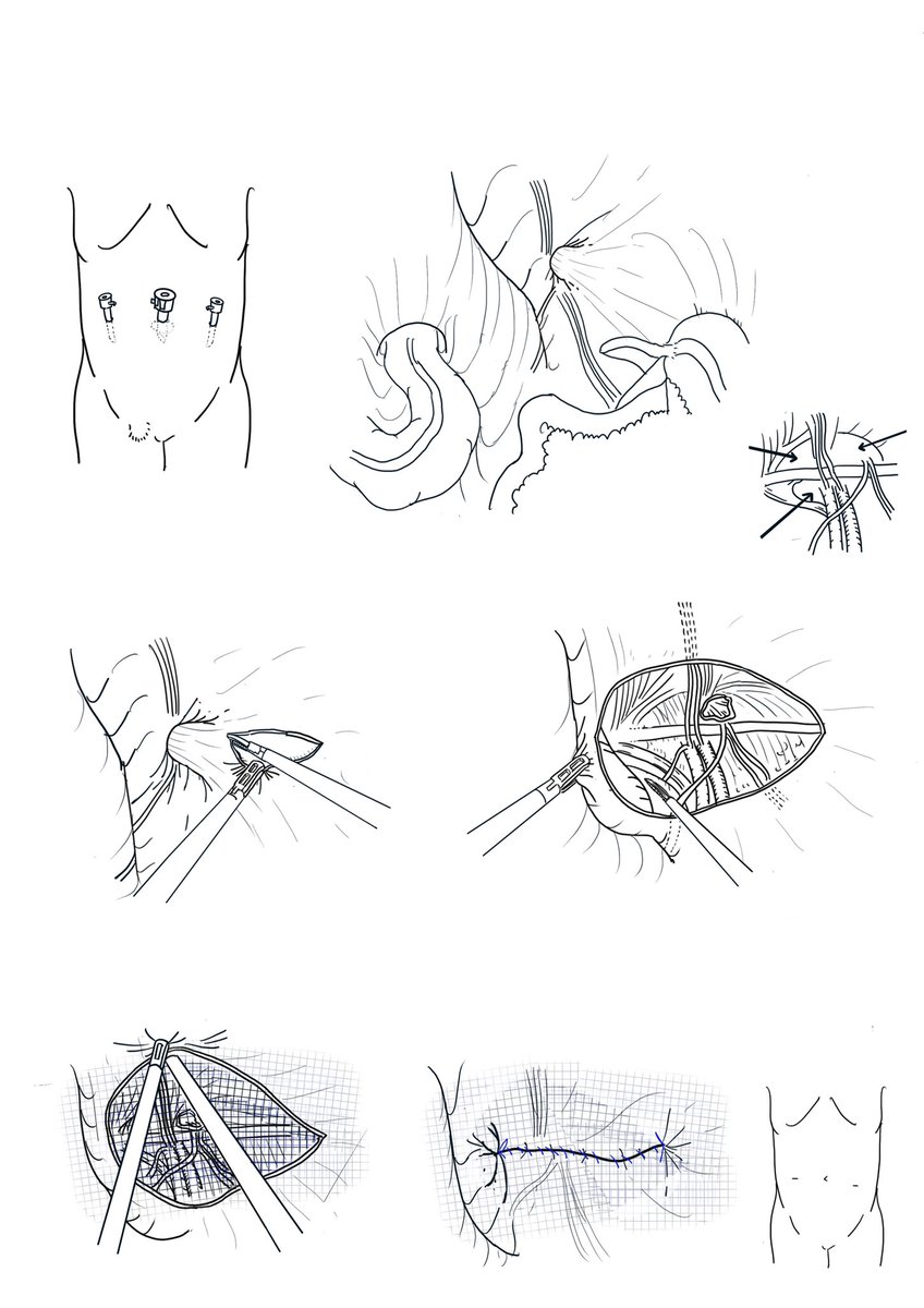 おぺなか V Twitter 腹腔鏡下鼠径ヘルニア修復術 レクチャー用 の線画まで 右外鼠径ヘルニアです ヘルニアの穴を腹腔側から見つけ 腹膜を剥がして 穴を覆うように広くメッシュを敷いて 腹膜を縫い閉じる 簡単にいえばそれだけですが 鼠径部の複雑さや 手術の