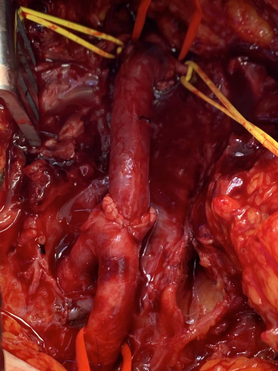 MCWVascSurg's tweet photo. A nice little contralateral femoral vein for a disrupted infected common femoral false aneurysm.  Balloon inflow occlusion is key to avoid a flank incision when BMI is 45 https://t.co/sMcFKpJV1V