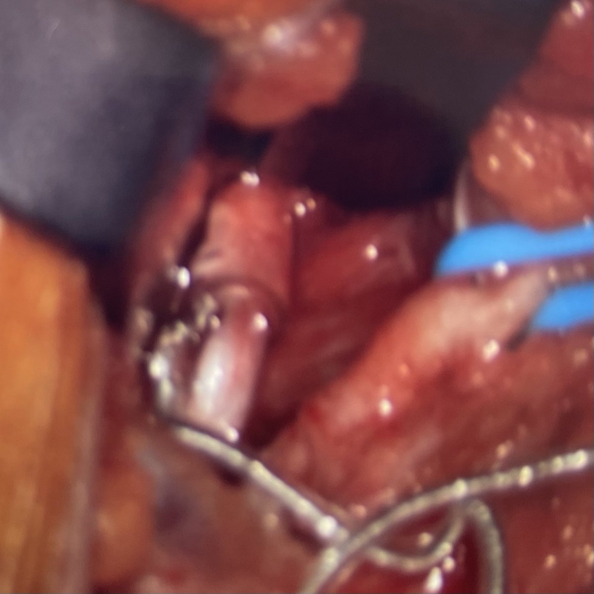 WilliamRBlythe's tweet photo. One OR. One OR Team. One surgeon. 4 Inspire surgeries sequentially and home before the local news! #teamwork #Inspire #sleepapnea #ENTLife https://t.co/hHyNq1FFlc