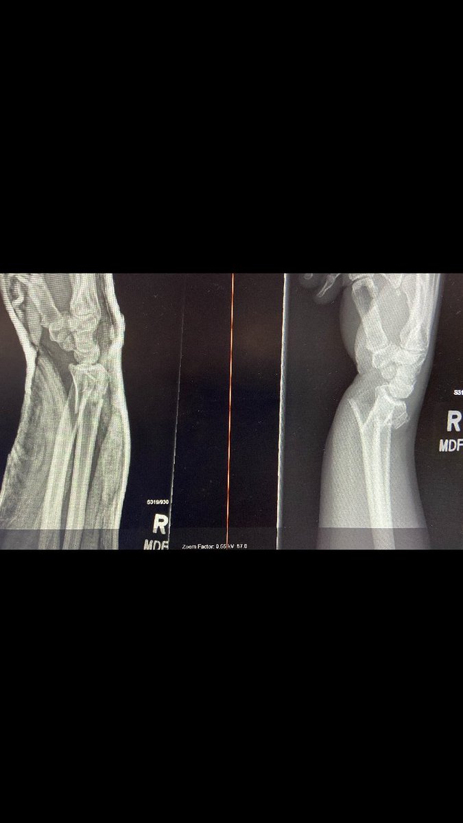 Facilitated by an US guided (bupivacaine) radial nerve block / hematoma block. In the hallway - by our illustrious senior resident Dr. Jacob Luther Denoncourt. No pain meds 👍 <a href="/mackendc/">David Mackenzie</a> <a href="/AndrewMFried/">Andrew Fried</a>