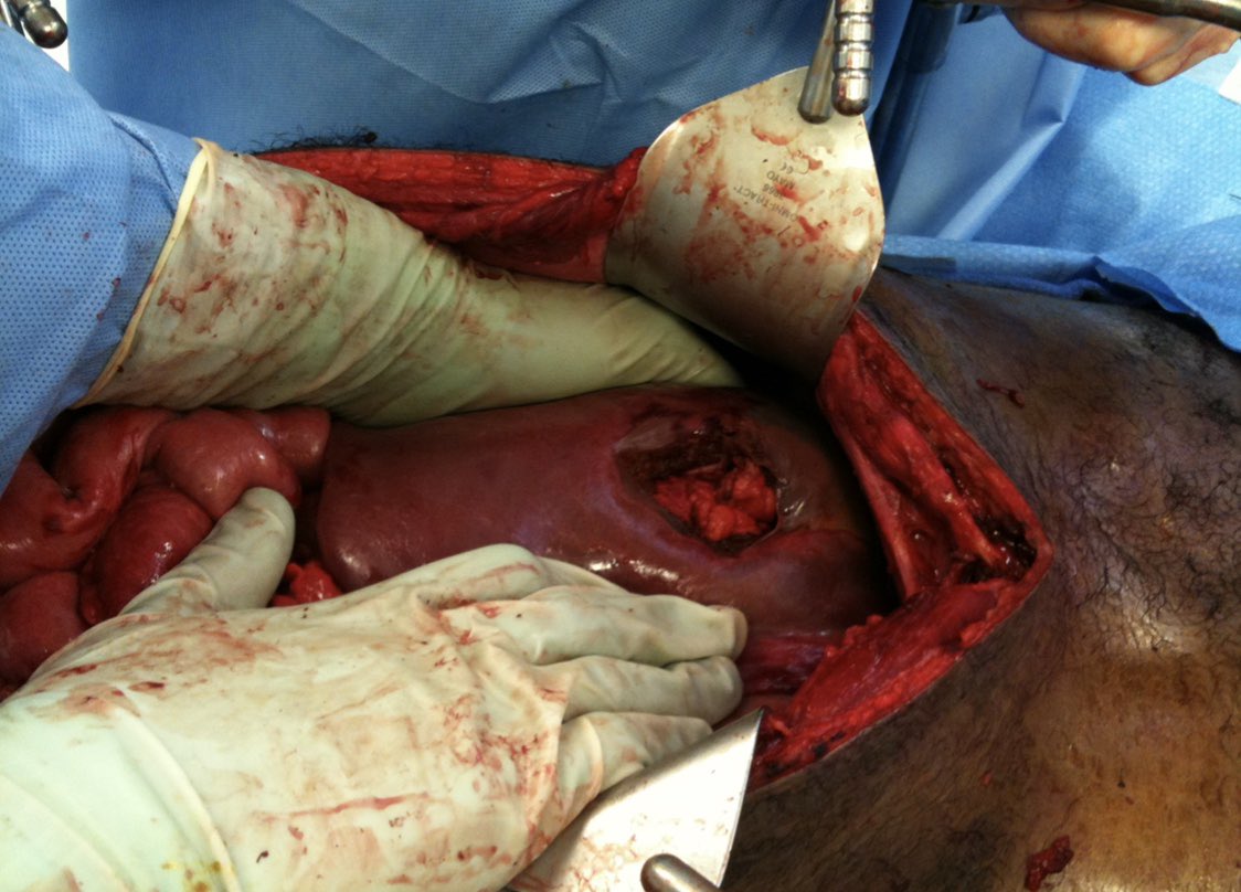 (image* <a href="/Mike_TruittMD/">Michael S. Truitt, MD CPE FACS</a>)

DMC-Emergency&amp;Trauma Centre is inviting you to Zoom meeting

Topic:DMC-ETC Half Academic Day
Presenter: Prof. Mansoor Khan 
Title: Liver Trauma 

Time: Mar 27, 2021 06:00 PM Riyadh

Join
us02web.zoom.us/j/81535303241?…
Meeting ID: 815 3530 3241
Passcode: 112021