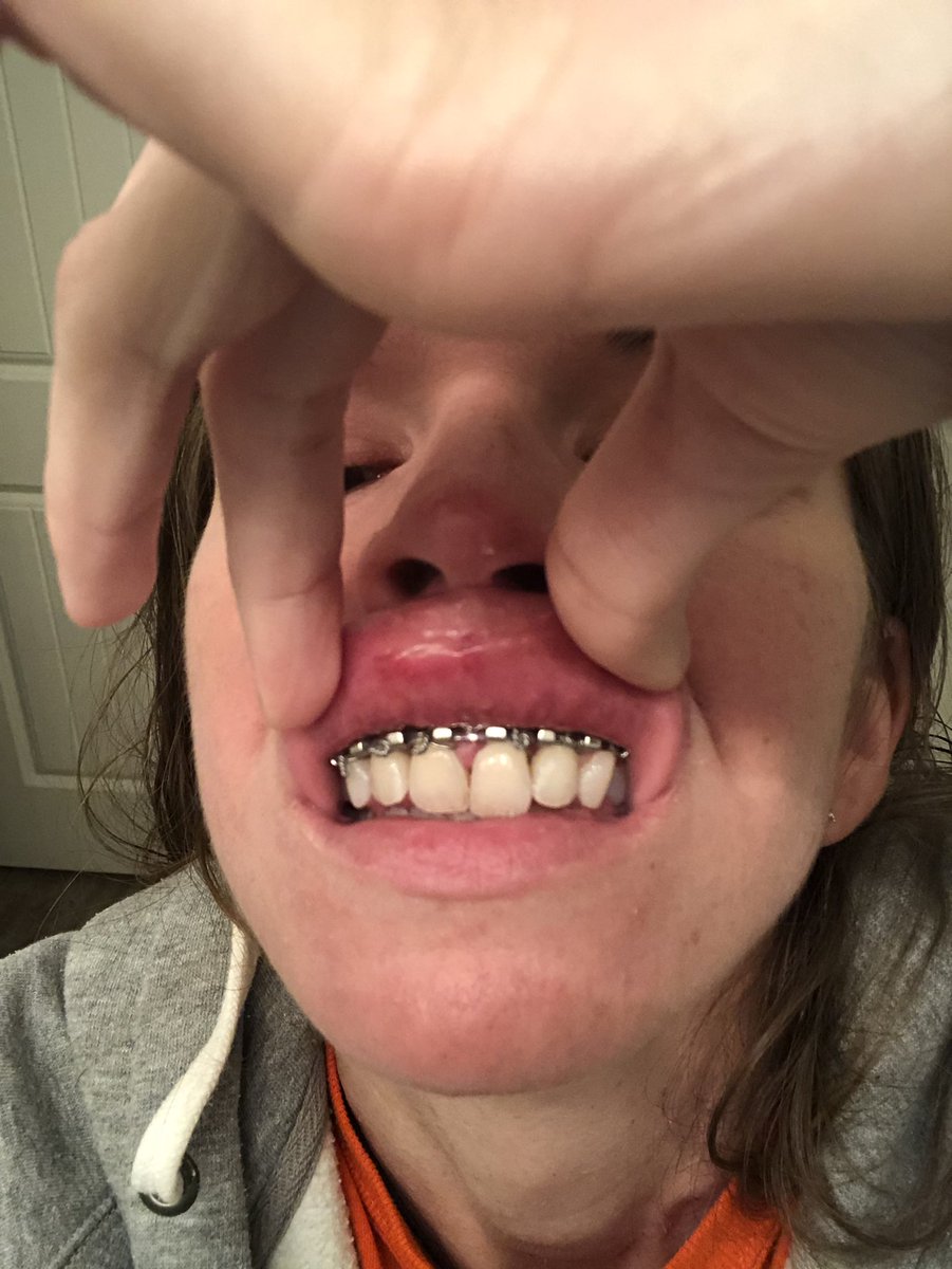 PinkSweets87's tweet photo. After shattering my Maxilla (still healing), my 2 Front Teeth pushed all the way back from their Sockets, he put in an #ArchBar. After 4 Weeks, he took it off and my Teeth stayed in. He told me that they had a 5% chance of Surviving. Thank You, Doctor Hinchey!
#Epilepsy https://t.co/PdmcOHRqWi