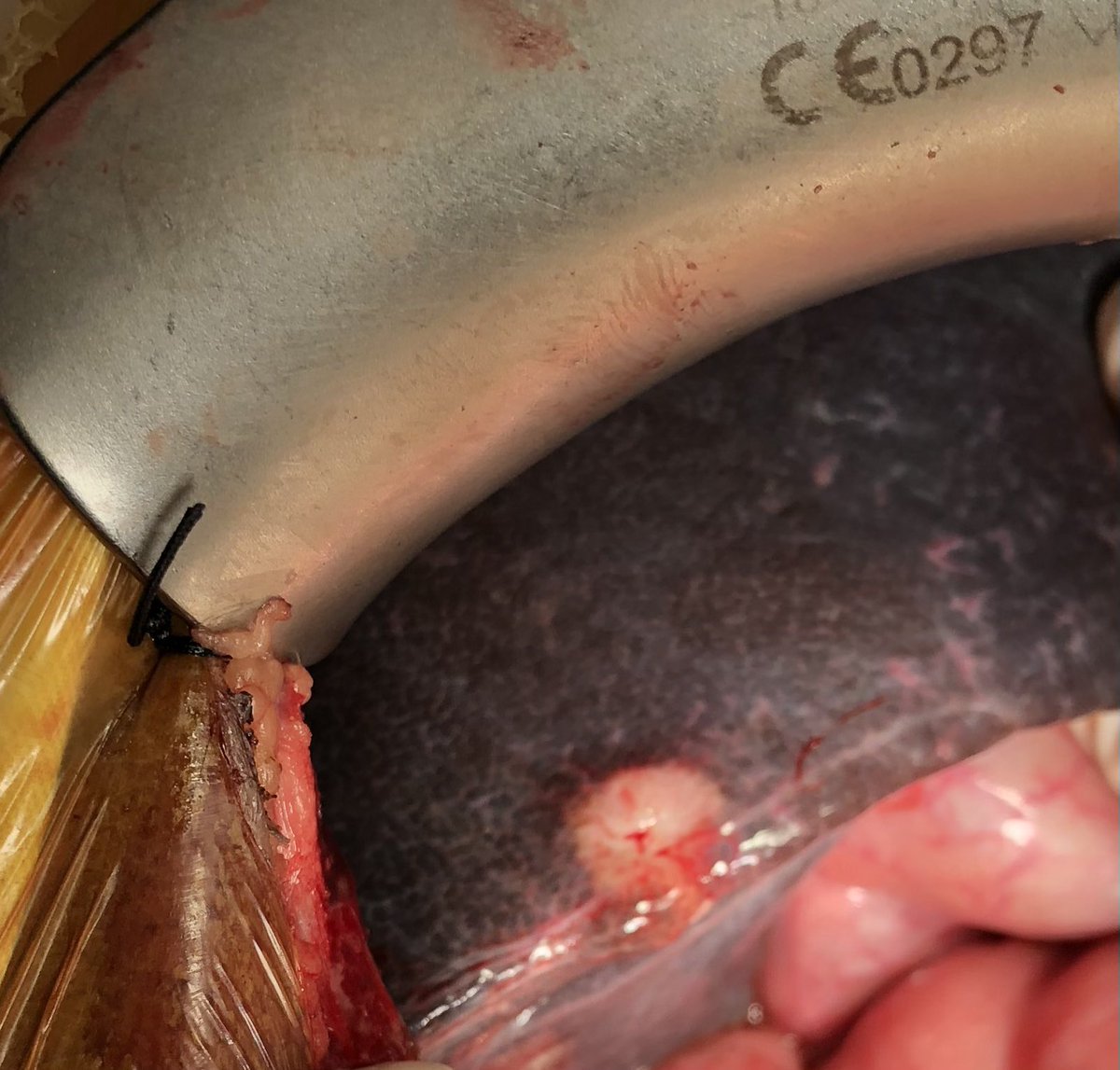 abubakarhaf's tweet photo. 35 y , M, peri ampullary adenoca. jaundice and GOO +. For PD. On laparotomy, 1.7 cm liver lesion in S5， reported as hemangioma on preop scan. Frozen=malignant epithelial cells. How do you proceed? @IHPBA @hpb_so https://t.co/qNb3X96XyW