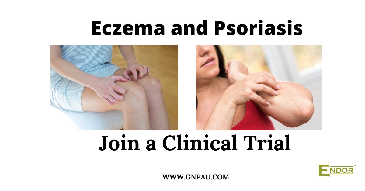 endor_gnp's tweet photo. Join a natural product clinical trial for moderate to severe Eczema and Psoriasis. https://t.co/GVvkhVDscp