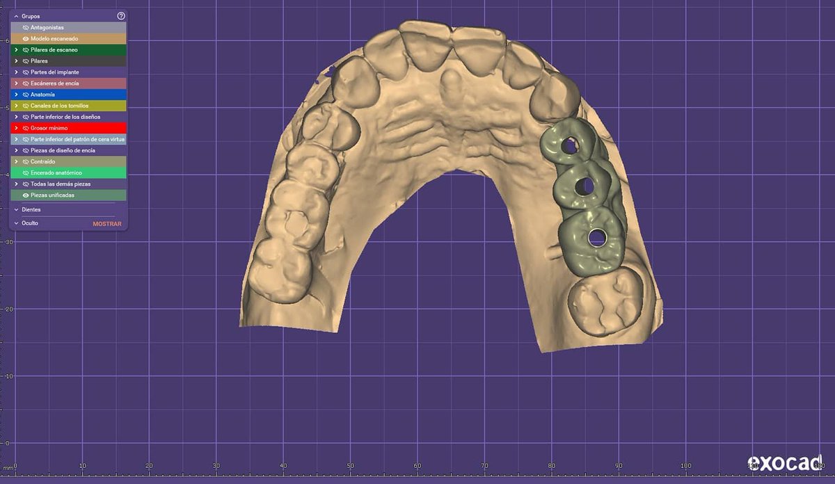 JobesaFormacion's tweet photo. Hoy os mostramos estas imágenes sobre implantología y encía virtual del máster de #exocad❗️
Nuestro chicos están aprendiendo como llevar acabo un puente monolítico sobre implantes con angulaciones y encía virtual en el entorno cad/cad.
¡Todo un emocionante reto aquí en #Jobesa! https://t.co/PGwa8J37cr