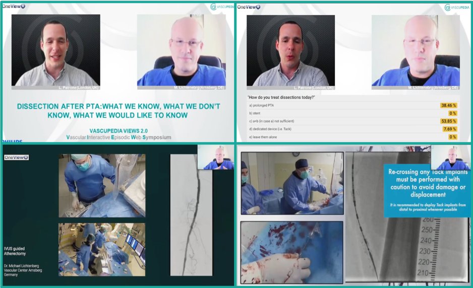 Vascupedia (@vascupedia_com) on Twitter photo Now online #VascupediaVIEWS - SFA/POP Episode 7
Dissection after PTA: what we know, what we don’t know, what we would like to know lnkd.in/d7AsGTJ
🎙Michael Lichtenberg🇩🇪
Moderator <a href="/LorenzoPatrone3/">Lorenzo Patrone</a>🇬🇧
supported by <a href="/PhilipsHealth/">Philips Healthcare</a>
<a href="/HadyLichaaMD/">Hady Lichaa, MD, FACC, FSCAI, FSVM, RPVI</a> <a href="/_backtable/">BackTable Vascular and Interventional</a> <a href="/SDhandMD/">Sabeen Dhand</a> Now online #VascupediaVIEWS - SFA/POP Episode 7
Dissection after PTA: what we know, what we don’t know, what we would like to know lnkd.in/d7AsGTJ
🎙Michael Lichtenberg🇩🇪
Moderator <a href="/LorenzoPatrone3/">Lorenzo Patrone</a>🇬🇧
supported by <a href="/PhilipsHealth/">Philips Healthcare</a>
<a href="/HadyLichaaMD/">Hady Lichaa, MD, FACC, FSCAI, FSVM, RPVI</a> <a href="/_backtable/">BackTable Vascular and Interventional</a> <a href="/SDhandMD/">Sabeen Dhand</a>