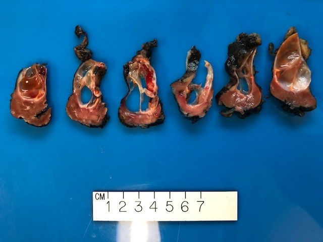 LaraHarikMD's tweet photo. Day#4 #pathfun #KidneyCancerAwarenessMonth
Inspired by @rovingatuscap
Guess the renal tumor subtype ?
#GUPATH #pathology #pathres #surgpath #pathgross https://t.co/KTX89Iu2KC